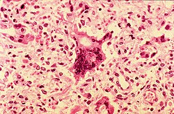 Photomicrograph of a lung tissue specimen, showing the histopathologic changes encountered in a case of measles pneumonia. Included in this view are numerous leukocytes and a multinucleated giant cell. Normal alveolar cytoarchitecture has been obliterated.[52]