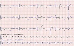 ECG: AMI with ST elevation in V2-4