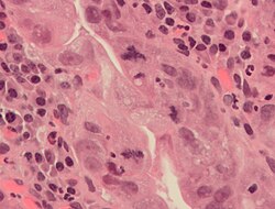 An abnormal (tripolar) mitosis (12 o'clock position) in a precancerous lesion of the stomach (H&E stain)