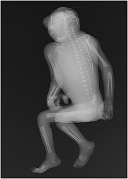 Fatal neural tube defect with evident anencephaly