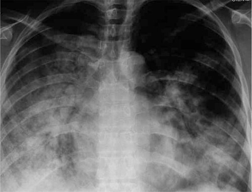 X-ray of 29-year-old person with H1N1