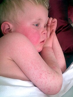 Characteristic red cheeks and rash of scarlet fever