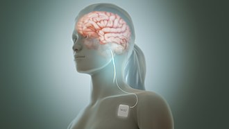Vagus nerve stimulator for epilepsy.