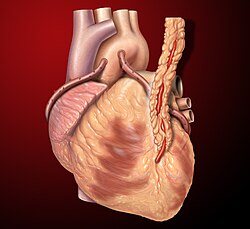 Three coronary artery bypass grafts, a pedicled LITA to LAD and two saphenous vein grafts – one to the right coronary artery system and one to the obtuse marginal system.