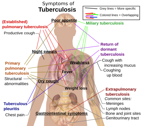 The main symptoms of variants and stages of tuberculosis are given,[5] with many symptoms overlapping with other variants, while others are more, but not entirely, specific for certain variants.
