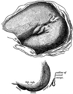 Tail-like structure on a female newborn from coccyx protrusion