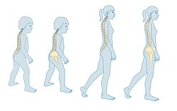 Diagram showing normal curvature of the vertebrae from childhood to teenage