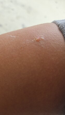 Serous fluid coming out of a mosquito bite.