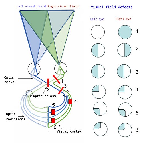 Visual pathway lesions From top to bottom: 1. Complete loss of vision in the right eye 2. Bitemporal hemianopia 3. Homonymous hemianopia 4. Quadrantanopia 5. & 6. Quadrantanopia with macular sparing