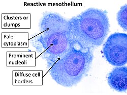 Cytology of reactive mesothelium, with typical features. The main causes of reactive mesothelium are infection, trauma and cancer.[3] Wright's stain.