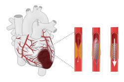 Inserting a stent to widen the artery