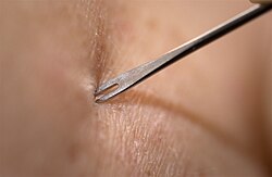 A demonstration by medical personnel on use of a bifurcated needle to deliver the smallpox vaccine, 2002