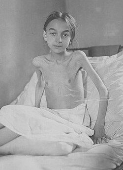 Press image of a malnourished German child with tuberculosis. Photo marked 1918–1920.