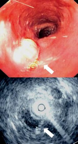 A mass seen during an endoscopy and an ultrasound of the mass conducted during the endoscopy session