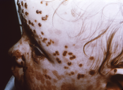 Modified smallpox in a 4-year-old child in Cardiff, Wales, 1962