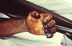 Tissue necrosis caused by plague infection.