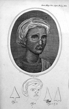 Illustration of an 18th-century nose reconstruction method from Poona performed by an Indian potter, from The Gentleman's Magazine, 1794