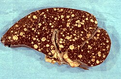 The spleen in a patient with miliary tuberculosis showing granulomas (tubercles)