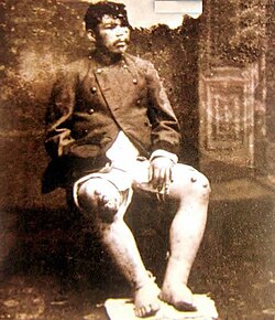 A Chilean soldier with the "Peruvian wart," or Carrion's disease, who was probably infected in the valleys of the Rimac River during the war in the sierra.[164]
