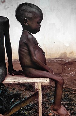 A girl during the Nigerian Civil War of the late 1960s. Pictures of the famine caused by the Nigerian blockade garnered sympathy for the Biafrans worldwide.