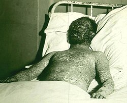 An unvaccinated person with probable hemorrhagic smallpox in a 1925 Milwaukee, Wisconsin epidemic. He later died of the disease.