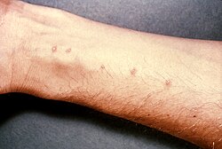 Skin vesicles created by the penetration of Schistosoma (Source: CDC)