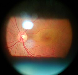 Fundoscopy by using 90 diopter lens with the slit lamp