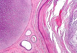 Micrograph of a teratoma, a tumour that characteristically has tissue from all three germ layers. The image shows tissue derived from the mesoderm (immature cartilage - left-upper corner of image), endoderm (gastrointestinal glands - center-bottom of image) and ectoderm (epidermis - right of image). H&E stain.