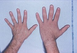 Normal-sized hand (left) and enlarged hand caused by acromegaly (right)