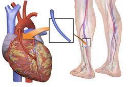 Illustration of a typical coronary artery bypass surgery. A vein from the leg is removed and grafted to the coronary artery to bypass a blockage at LAD.