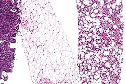 Micrograph showing some dedifferentiation, (at left edge of image). + A differentiated component, showing lipoblasts and increased vascularity, (right edge of image). + Fully differentiated adipose tissue, showing a few blood vessels, (center of image). (Micrograph of liposarcoma prepared with H&E stain).