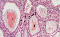 Section of a thyroid gland under the microscope. 1 colloid, 2 follicular cells, 3 endothelial cells
