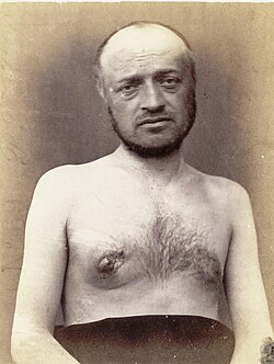 Man with breast cancer, 1871.