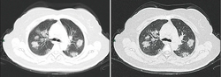 CT scan of rapid progression stage of COVID-19
