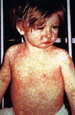 A child with measles, a vaccine-preventable disease[18]