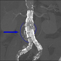Abdominal aortic endoprosthesis, CT scan, original aneurysm marked in blue