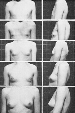 Tanner stages of breast development.