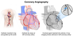 With a coronary angiography, stenotic lesions of the coronary arteries are identified.