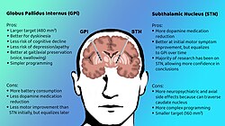 STN vs GPi with probe locations and pros and cons of each
