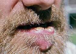 Tuberculosis of the lip, secondary to open pulmonary TB