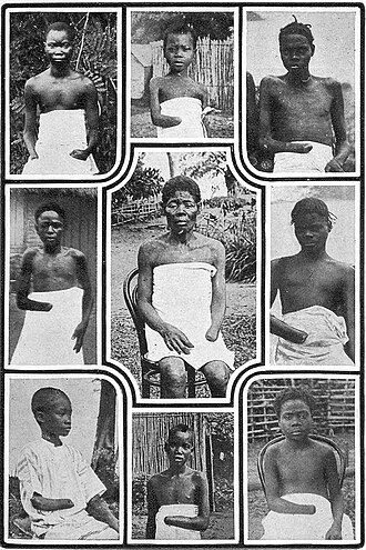 From 1885 to 1908, many atrocities were perpetrated in the Congo Free State; in these images, Native Congo Free State labourers who failed to meet rubber collection quotas have been punished by having their hands cut off.