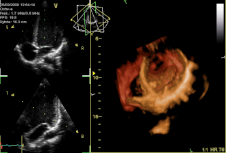 3D - loop of a heart viewed from the apex, with the apical part of the ventricles removed and the mitral valve clearly visible. Due to missing data, the leaflets of the tricuspid and aortic valves are not clearly visible, but the openings are; the pulmonary valve is not visible. On the left are two standard 2D views (taken from the 3D dataset) showing tricuspid and mitral valves (above) and aortal valve (below).