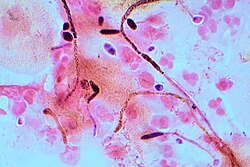 Gram stain of Candida albicans from a vaginal swab from a woman with candidiasis, showing hyphae, and chlamydospores, which are 2–4 μm in diameter
