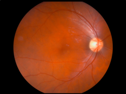Fundus photograph showing the blood vessels in a normal human retina. Veins are darker and slightly wider than corresponding arteries. The optic disc is at right, and the macula lutea is near the centre.