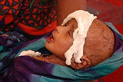 A Somali boy receiving treatment for malnutrition at a health facility in Hilaweyn during the drought of 2011.