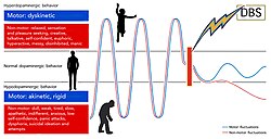 DBS improves non-axial motor symptoms with Parkinson's, leading to a new chronic phenotype dominated by axial motor symptoms (gait dysfunction, dysarthria, camptocormia) and cognitive decline, features which generally do not improve and can worsen after surgery.