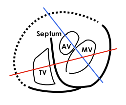 This is further explanation of the echocardiogram above. MV: Mitral valve, TV: Tricuspid valve, AV: Aortic valve, Septum: Interventricular septum. Continuous lines demarcate septum and free wall seen in echocardiogram, dotted line is a suggestion of where the free wall of the right ventricle should be. The red line represents where the upper left loop in the echocardiogram transects the 3D-loop, the blue line represents the lower loop.