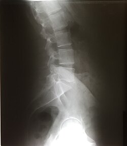 Lateral lumbar X-ray of a 34-year-old male