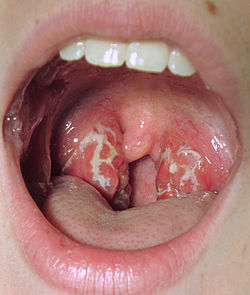 Throat of a child with a positive throat culture for streptococcal pharyngitis, with enlarged tonsils clearly visible.