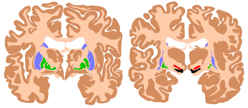 Components of the basal ganglia, shown in two cross-sections of the human brain. Blue: caudate nucleus and putamen. Green: globus pallidus. Red: subthalamic nucleus. Black: substantia nigra.